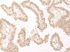 Immunohistochemistry of paraffin-embedded Human thyroid cancer tissue  using PBXIP1 Polyclonal Antibody at dilution of 1:40(×200)