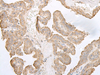 Immunohistochemistry of paraffin-embedded Human thyroid cancer tissue  using PFKM Polyclonal Antibody at dilution of 1:60(×200)