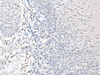 Immunohistochemistry of paraffin-embedded Human esophagus cancer tissue  using EPM2A Polyclonal Antibody at dilution of 1:55(×200)