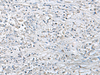 Immunohistochemistry of paraffin-embedded Human liver cancer tissue  using EPM2A Polyclonal Antibody at dilution of 1:55(×200)