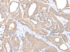 Immunohistochemistry of paraffin-embedded Human thyroid cancer tissue  using C9orf116 Polyclonal Antibody at dilution of 1:55(×200)