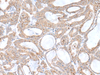 Immunohistochemistry of paraffin-embedded Human thyroid cancer tissue  using PLGLB2 Polyclonal Antibody at dilution of 1:65(×200)