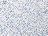 Immunohistochemistry of paraffin-embedded Human cervical cancer tissue  using STAU2 Polyclonal Antibody at dilution of 1:45(×200)