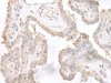 Immunohistochemistry of paraffin-embedded Human thyroid cancer tissue  using STAU2 Polyclonal Antibody at dilution of 1:45(×200)