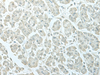 Immunohistochemistry of paraffin-embedded Human gastric cancer tissue  using C8orf4 Polyclonal Antibody at dilution of 1:55(×200)