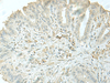 Immunohistochemistry of paraffin-embedded Human thyroid cancer tissue  using C8orf4 Polyclonal Antibody at dilution of 1:55(×200)