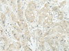 Immunohistochemistry of paraffin-embedded Human breast cancer tissue  using MIEN1 Polyclonal Antibody at dilution of 1:45(×200)