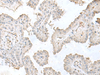Immunohistochemistry of paraffin-embedded Human thyroid cancer tissue  using LSM10 Polyclonal Antibody at dilution of 1:50(×200)