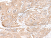 Immunohistochemistry of paraffin-embedded Human esophagus cancer tissue  using SNRNP25 Polyclonal Antibody at dilution of 1:65(×200)