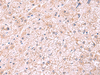 Immunohistochemistry of paraffin-embedded Human liver cancer tissue  using PDRG1 Polyclonal Antibody at dilution of 1:75(×200)