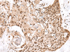 Immunohistochemistry of paraffin-embedded Human esophagus cancer tissue  using MAGOHB Polyclonal Antibody at dilution of 1:70(×200)