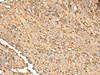 Immunohistochemistry of paraffin-embedded Human cervical cancer tissue  using UBE2A Polyclonal Antibody at dilution of 1:45(×200)