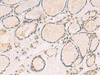 Immunohistochemistry of paraffin-embedded Human thyroid cancer tissue  using TCAP Polyclonal Antibody at dilution of 1:55(×200)