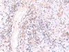 Immunohistochemistry of paraffin-embedded Human cervical cancer tissue  using MRPS24 Polyclonal Antibody at dilution of 1:90(×200)