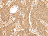 Immunohistochemistry of paraffin-embedded Human esophagus cancer tissue  using TIPRL Polyclonal Antibody at dilution of 1:60(×200)