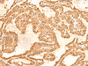 Immunohistochemistry of paraffin-embedded Human thyroid cancer tissue  using TIPRL Polyclonal Antibody at dilution of 1:60(×200)