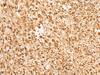 Immunohistochemistry of paraffin-embedded Human liver cancer tissue  using JPT2 Polyclonal Antibody at dilution of 1:65(×200)