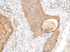 Immunohistochemistry of paraffin-embedded Human esophagus cancer tissue  using TOR1A Polyclonal Antibody at dilution of 1:35(×200)