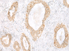 Immunohistochemistry of paraffin-embedded Human breast cancer tissue  using TOR1A Polyclonal Antibody at dilution of 1:35(×200)