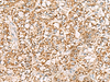 Immunohistochemistry of paraffin-embedded Human liver cancer tissue  using ISOC2 Polyclonal Antibody at dilution of 1:95(×200)