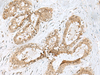 Immunohistochemistry of paraffin-embedded Human breast cancer tissue  using PSMA4 Polyclonal Antibody at dilution of 1:45(×200)