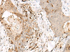 Immunohistochemistry of paraffin-embedded Human esophagus cancer tissue  using OVOL2 Polyclonal Antibody at dilution of 1:50(×200)