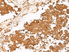 Immunohistochemistry of paraffin-embedded Human lung cancer tissue  using HUS1 Polyclonal Antibody at dilution of 1:65(×200)