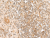 Immunohistochemistry of paraffin-embedded Human prost ate cancer tissue  using HUS1 Polyclonal Antibody at dilution of 1:65(×200)