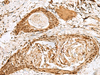 Immunohistochemistry of paraffin-embedded Human esophagus cancer tissue  using SNAPC1 Polyclonal Antibody at dilution of 1:40(×200)