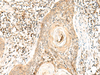 Immunohistochemistry of paraffin-embedded Human esophagus cancer tissue  using POLR1E Polyclonal Antibody at dilution of 1:40(×200)