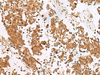 Immunohistochemistry of paraffin-embedded Human lung cancer tissue  using SCRN2 Polyclonal Antibody at dilution of 1:60(×200)