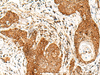 Immunohistochemistry of paraffin-embedded Human esophagus cancer tissue  using SMOC1 Polyclonal Antibody at dilution of 1:50(×200)