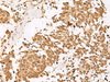 Immunohistochemistry of paraffin-embedded Human lung cancer tissue  using PSMD12 Polyclonal Antibody at dilution of 1:40(×200)