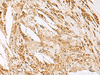 Immunohistochemistry of paraffin-embedded Human thyroid cancer tissue  using DNPEP Polyclonal Antibody at dilution of 1:60(×200)