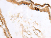 Immunohistochemistry of paraffin-embedded Human thyroid cancer tissue  using RABGGTA Polyclonal Antibody at dilution of 1:50(×200)