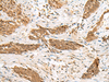 Immunohistochemistry of paraffin-embedded Human esophagus cancer tissue  using NUP58 Polyclonal Antibody at dilution of 1:50(×200)