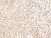 Immunohistochemistry of paraffin-embedded Human liver cancer tissue  using NGEF Polyclonal Antibody at dilution of 1:35(×200)