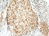 Immunohistochemistry of paraffin-embedded Human esophagus cancer tissue  using RBM10 Polyclonal Antibody at dilution of 1:55(×200)