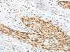 Immunohistochemistry of paraffin-embedded Human esophagus cancer tissue  using RBM12 Polyclonal Antibody at dilution of 1:50(×200)