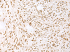 Immunohistochemistry of paraffin-embedded Human liver cancer tissue  using TCOF1 Polyclonal Antibody at dilution of 1:50(×200)