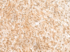 Immunohistochemistry of paraffin-embedded Human liver cancer tissue  using RBM19 Polyclonal Antibody at dilution of 1:45(×200)