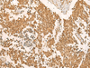 Immunohistochemistry of paraffin-embedded Human lung cancer tissue  using EFTUD2 Polyclonal Antibody at dilution of 1:45(×200)