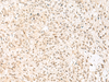 Immunohistochemistry of paraffin-embedded Human liver cancer tissue  using RBX1 Polyclonal Antibody at dilution of 1:50(×200)