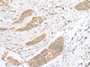 Immunohistochemistry of paraffin-embedded Human esophagus cancer tissue  using ENSA Polyclonal Antibody at dilution of 1:40(×200)