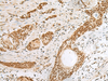 Immunohistochemistry of paraffin-embedded Human esophagus cancer tissue  using PNRC2 Polyclonal Antibody at dilution of 1:30(×200)