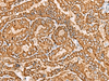 Immunohistochemistry of paraffin-embedded Human thyroid cancer tissue  using NPC2 Polyclonal Antibody at dilution of 1:80(×200)