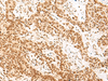 Immunohistochemistry of paraffin-embedded Human ovarian cancer tissue  using NHP2 Polyclonal Antibody at dilution of 1:55(×200)