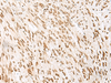 Immunohistochemistry of paraffin-embedded Human liver cancer tissue  using NHP2 Polyclonal Antibody at dilution of 1:55(×200)