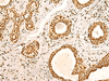 Immunohistochemistry of paraffin-embedded Human breast cancer tissue  using ILF3 Polyclonal Antibody at dilution of 1:60(×200)
