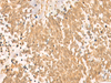 Immunohistochemistry of paraffin-embedded Human lung cancer tissue  using UBD Polyclonal Antibody at dilution of 1:50(×200)
